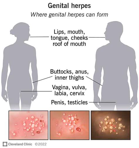 Genital herpes